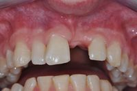 Single Tooth Implant 3 before